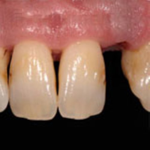 Immediate Implant placement in the esthetic area by Dominik Büchi